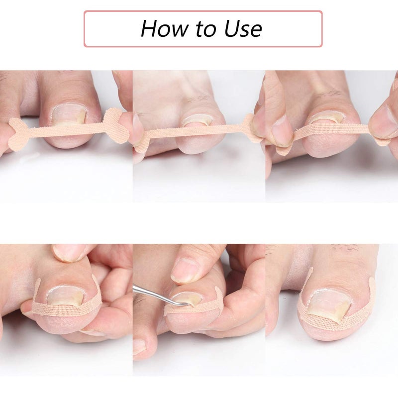 EBANKU Ingrown Toenail Treatment Strips, 20 Pcs Toe Nail Correction Patch Elastic Patch Sticker Corrector Pedicure Tools Fingernail Toe Nail Care - Image 4